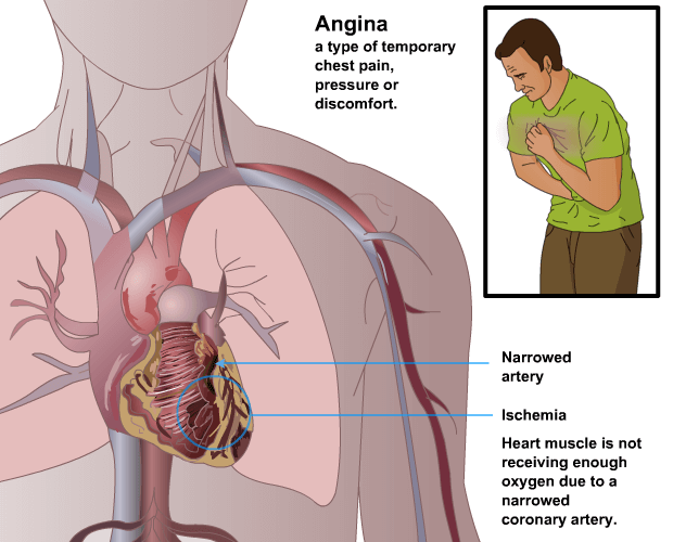 Angina