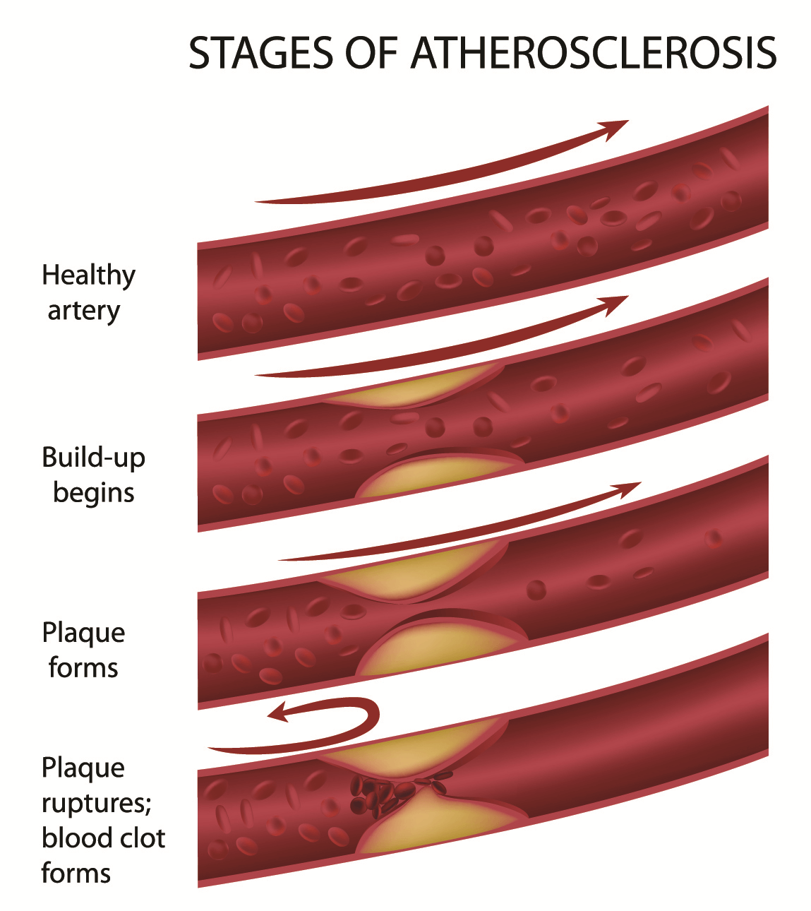 Arrhythmia